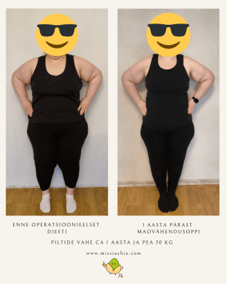 enne ja pärast pilt otsevaates, maovähendusoperatsioon mini gastric bypass