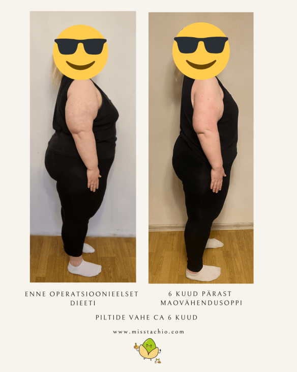 kuus kuud pärast maovähendusoperatsiooni vs enne 