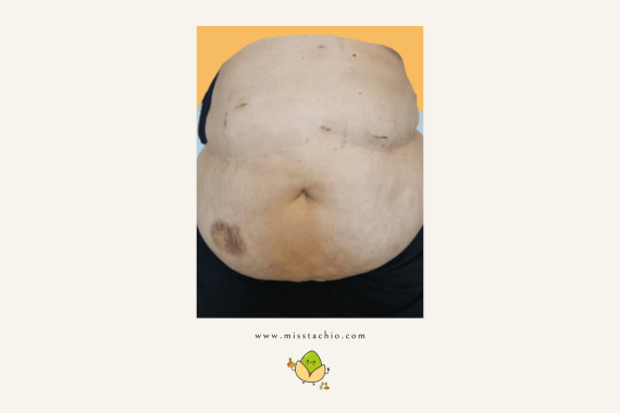 wounds healing after weight loss surgery, week 2