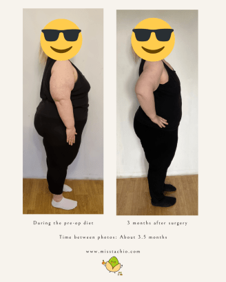 Gastric Bypass Surgery Results After 3 Months - before and after photo